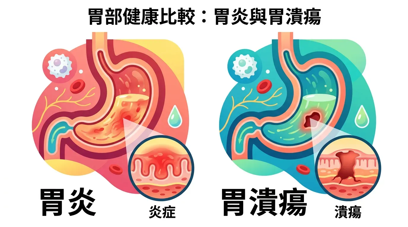 症狀辨識：是胃炎還是潰瘍